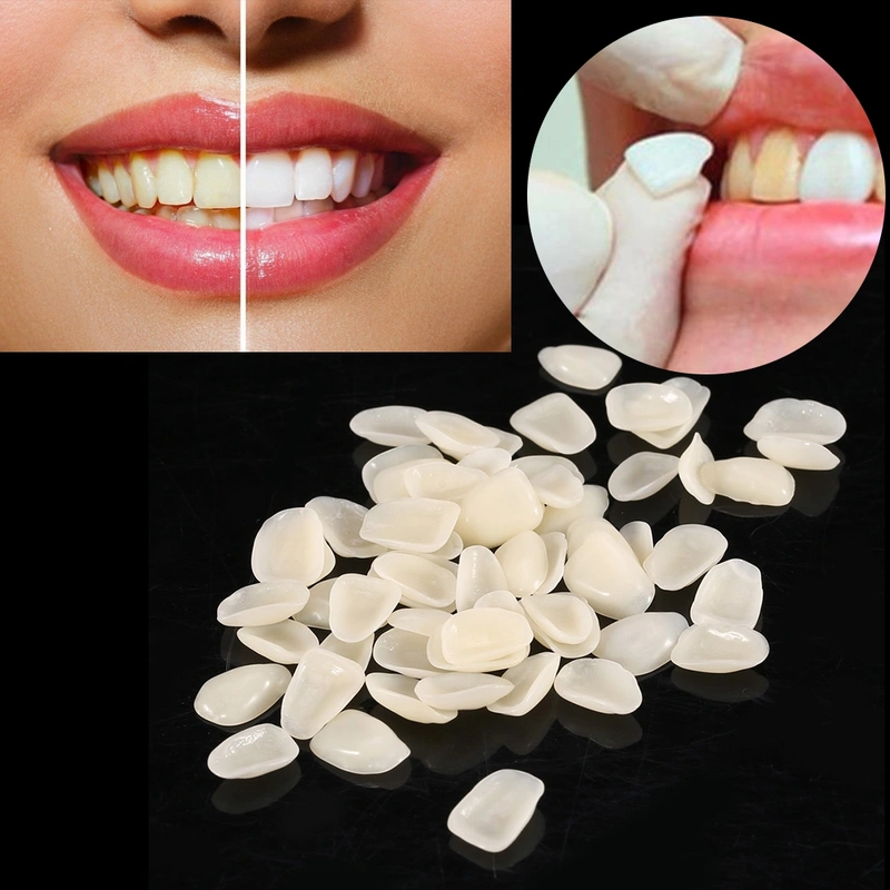 70PCS/Bag Teeth Veneers Resin Anterior Upper Temporary Crown For Dental