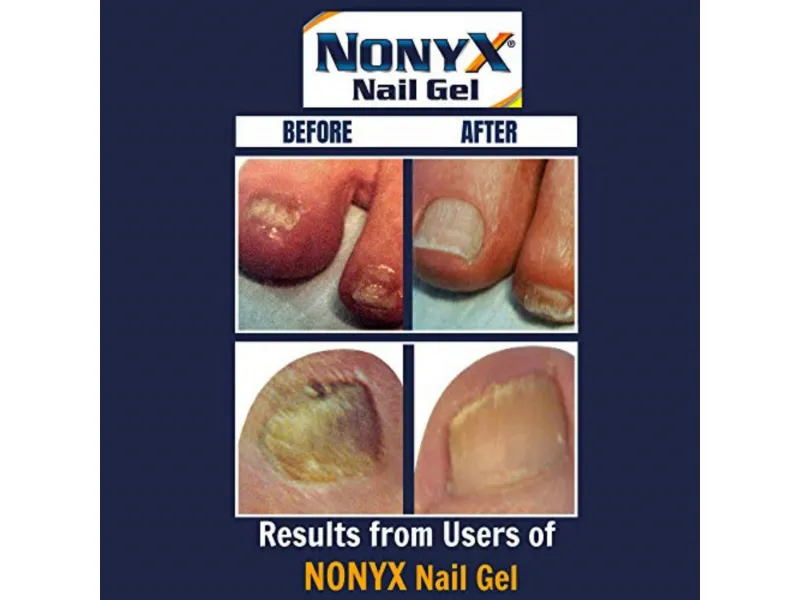 Nonyx Fungal Nail Clarifying Gel, Clears Out Keratin Debris Where Nail  Fungus Thrives, 4 Oz. | Wholesale | Tradeling